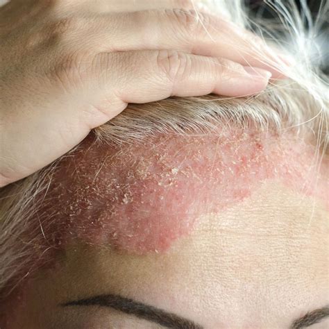 Psoriasis Scalp Treatment Natural