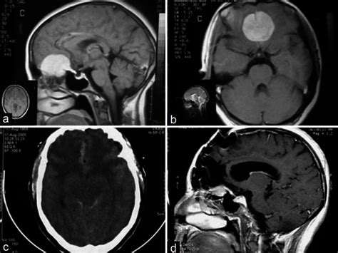 A And B Pre Operative Sagittal And Axial T1 Weighted Mri With Download Scientific Diagram