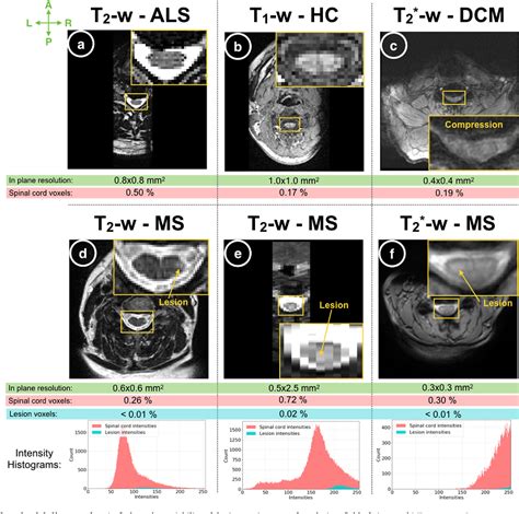 Figure 1 From Automatic Segmentation Of The Spinal Cord And Intramedullary Multiple Sclerosis