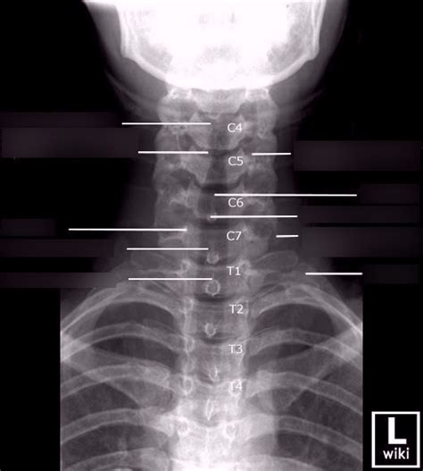 AP Soft Tissue Neck X-Ray Anatomy Diagram | Quizlet