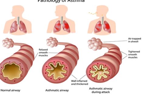 Pulmonology Asthma Flashcards Quizlet