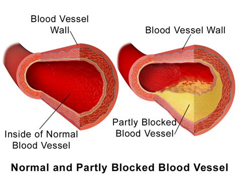 Atherosclerosis Causes Symptoms A Level Biology Notes