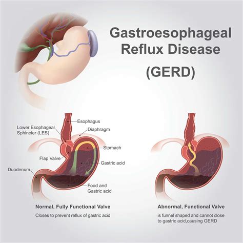 Tif Procedure For Frequent Heartburn Krmc Kingman Regional Medical