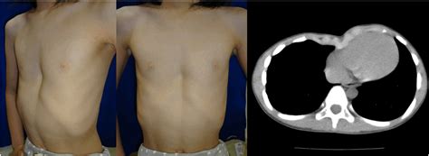 Nuss Procedure For Patients With Pectus Excavatum With A History Of