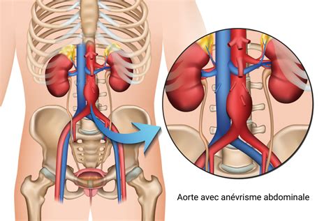 An Vrisme De Laorte Clinique Pierre Larose