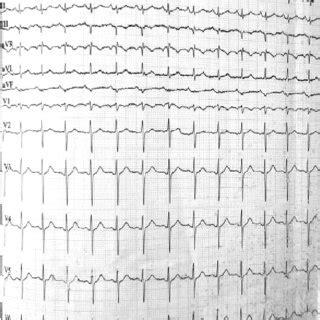 12 Leads Electrocardiogram EKG Sinus Tachycardia Normal QRS Complex