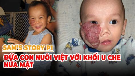 Việt Bao La Sam s Story P1 Đứa con nuôi Việt với khối u che nửa mặt