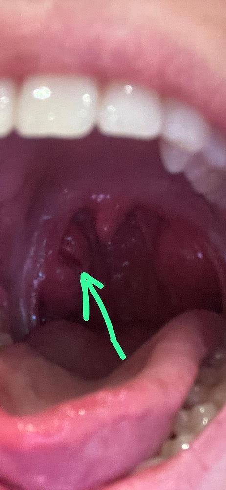 Tonsil Cracks Cervices And Holes