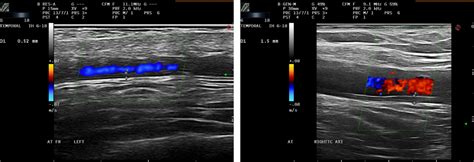 Temporal Artery Ultrasound