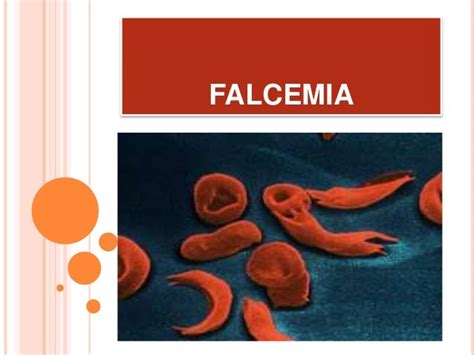 Falcemia