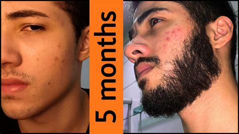 Minoxidil Beard Journey 5 Months Transformation Youtube