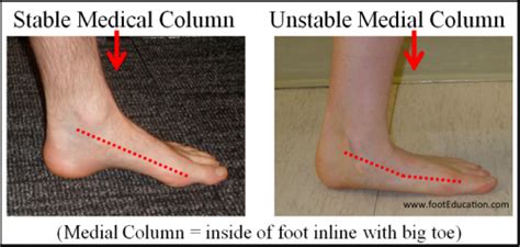 Characteristics of a Flat Foot - FootEducation