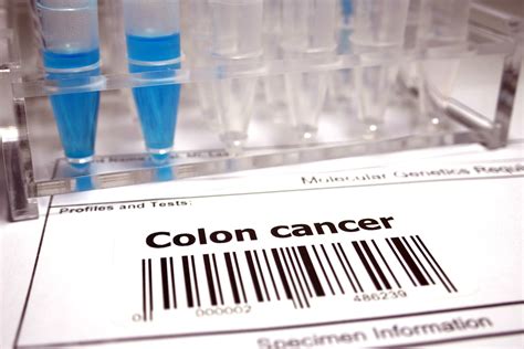 Study: Colon cancer screenings are more effective than previously ...