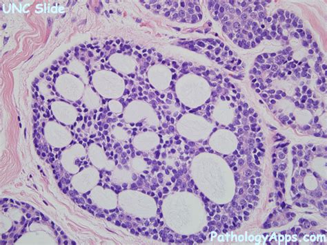 Adenoid Cystic Carcinoma Pathology