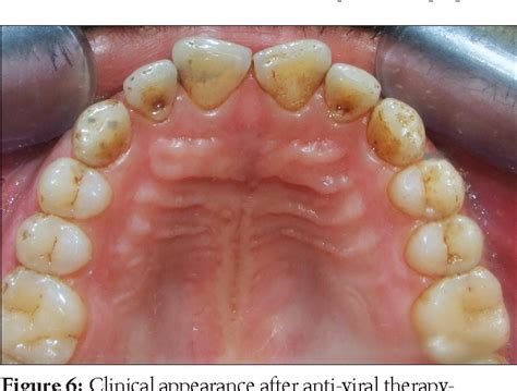 Figure 2 From Acute Herpetic Gingivostomatitis Associated With Herpes