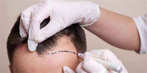 10 Things To Avoid After Hair Transplant Procedure