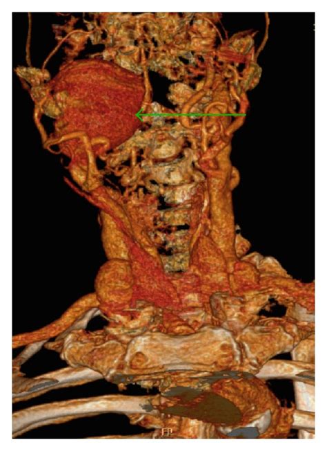 Internal Carotid Artery Aneurysm Mimicking Peritonsillar Abscess