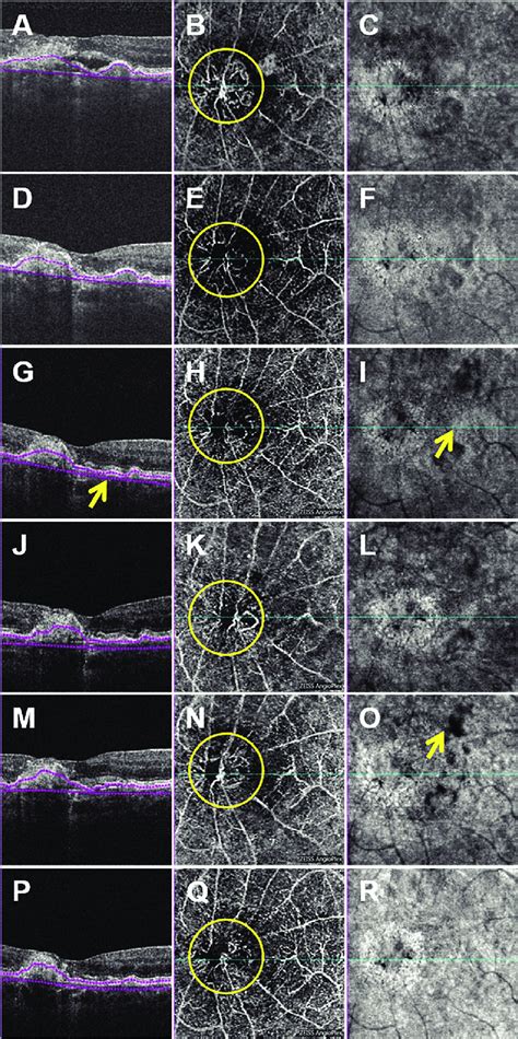 Case 1: Spectral-domain optical coherence tomography angiography ...
