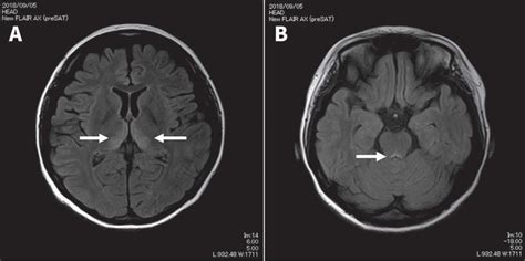 Wernickes Encephalopathy Causes Symptoms Diagnosis Treatment