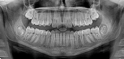 What Is Lockjaw The Symptoms Causes And Treatment Dentists In