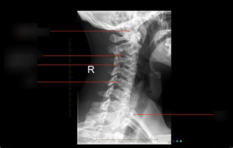 Oblique Projection Of C Spine Diagram Quizlet