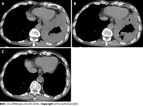 Immune Checkpoint Inhibitor Associated Arthritis In Advanced Pulmonary Adenocarcinoma A Case Report