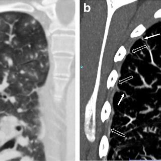 Pulmonary Hypertension In An Year Old Girl With Bmpr Mutation