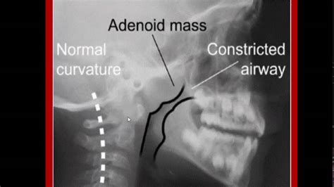 Adeniod Imaging Youtube