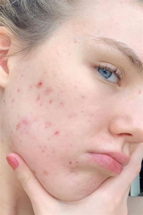 Accutane Before And After 9 Women On Their Isotretinoin Side Effects