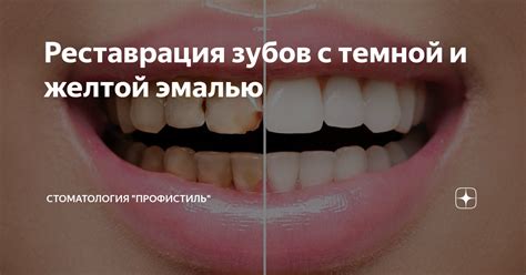 Реставрация зубов с темной и желтой эмалью | Стоматология "ПрофиСтиль ...