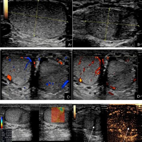 Scrotal Ultrasound Findings At Three Months Postoperatively A B 2d