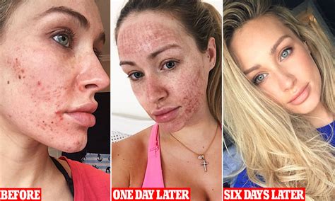 Pixel Laser After Treatment