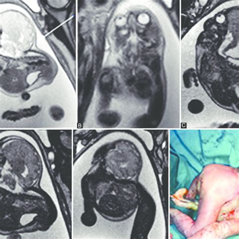 A G Cystic Hygroma In A Fetus At 31 Weeks T2wi Sagittal A And Download Scientific