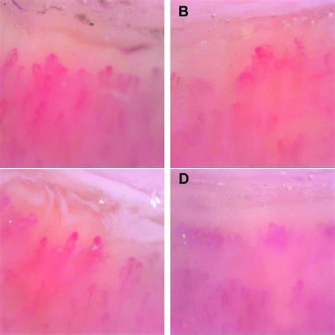 Nailfold Capillaroscopy 200 X Magnification Capillary Abnormalities