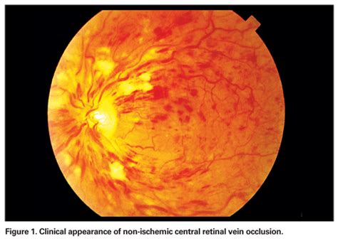 Retinal vein occlusion; Thrombosis, Retinal Vein