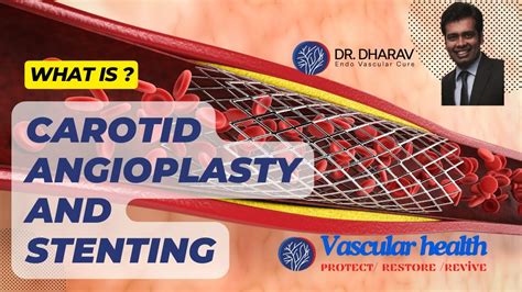 What Is Carotid Angioplasty And Stentingstroke Prevention Dr Dharav