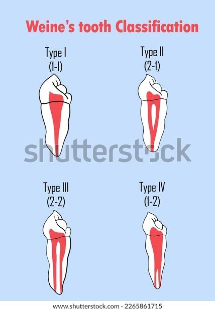 Classification Root Canal Morphology Type Type Stock Illustration 2265861715 | Shutterstock