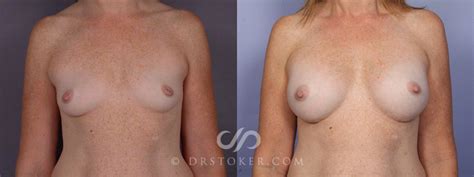 Nipple Inversion Correction Before And After Pictures Case Los