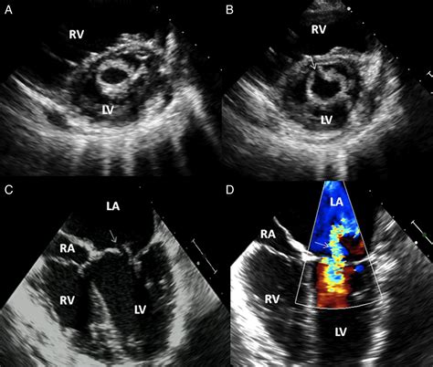 Update On Percutaneous Mitral Commissurotomy Heart