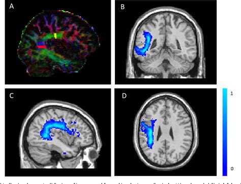 Figure 2 From Contributions Of Bilateral White Matter To Chronic