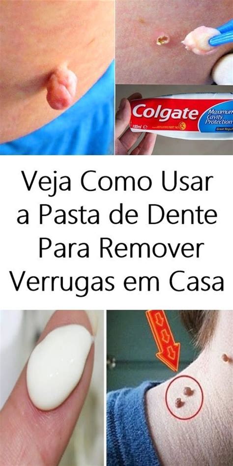 Veja Como Usar A Pasta De Dente Para Remover Verrugas Eliminar Las