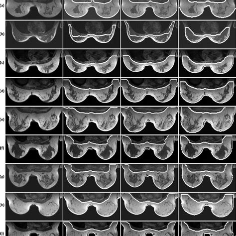 PDF Breast Segmentation In MRI Quantitative Evaluation Of Three Methods