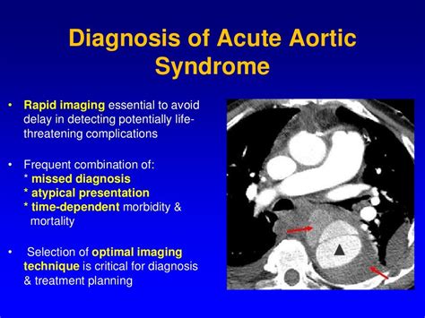 Final Acute Aortic Syndrome Dr Sanjiv