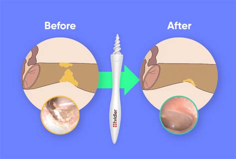 Can Impacted Earwax Cause Jaw Pain? | Mewing.coach