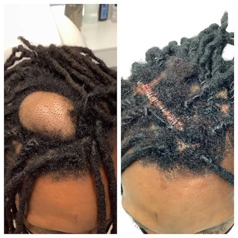 Cyst And Lipoma Removal Before And After St Louis St Louis