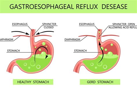 Acid Reflux Symptoms And Causes