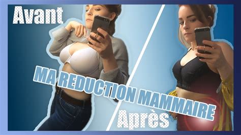 Reduction Mammaire Avant Et Apres Des Photos Trolmentpopiforkma Over