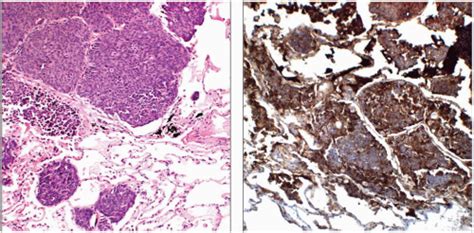 Neuroendocrine Small Cell Carcinoma Basicmedical Key