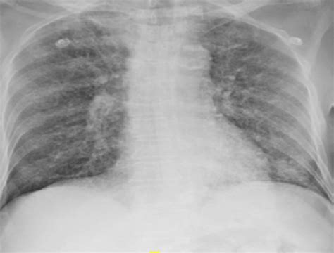 Chest Radiograph Postero Anterior View At Admission Showing Bilateral