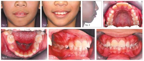 Treatment Of Class Ii Division I Malocclusion With Deep Bite In Mixed Dentition Requiring Early